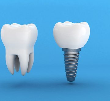 Do Dental Implants Really Work?