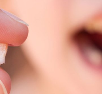 Tooth Removal/Tooth Extractions