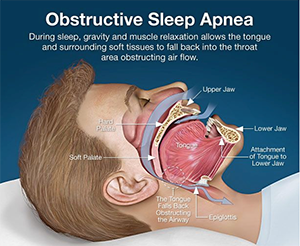 Obstructive Sleep Apnea Explanation