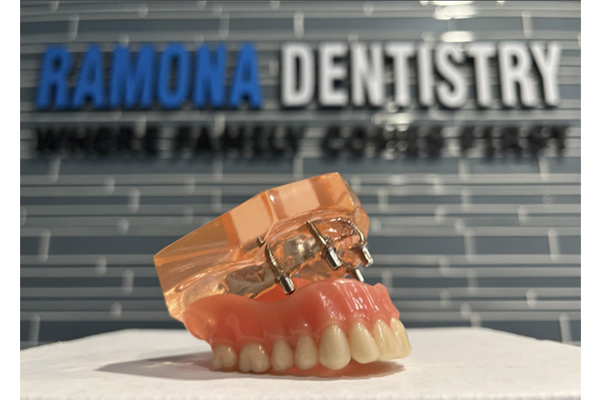 Top Arch Dental Implant model